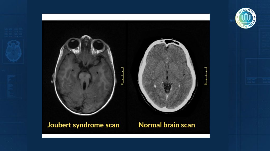 One in 100,000: Raising a baby with Joubert Syndrome 